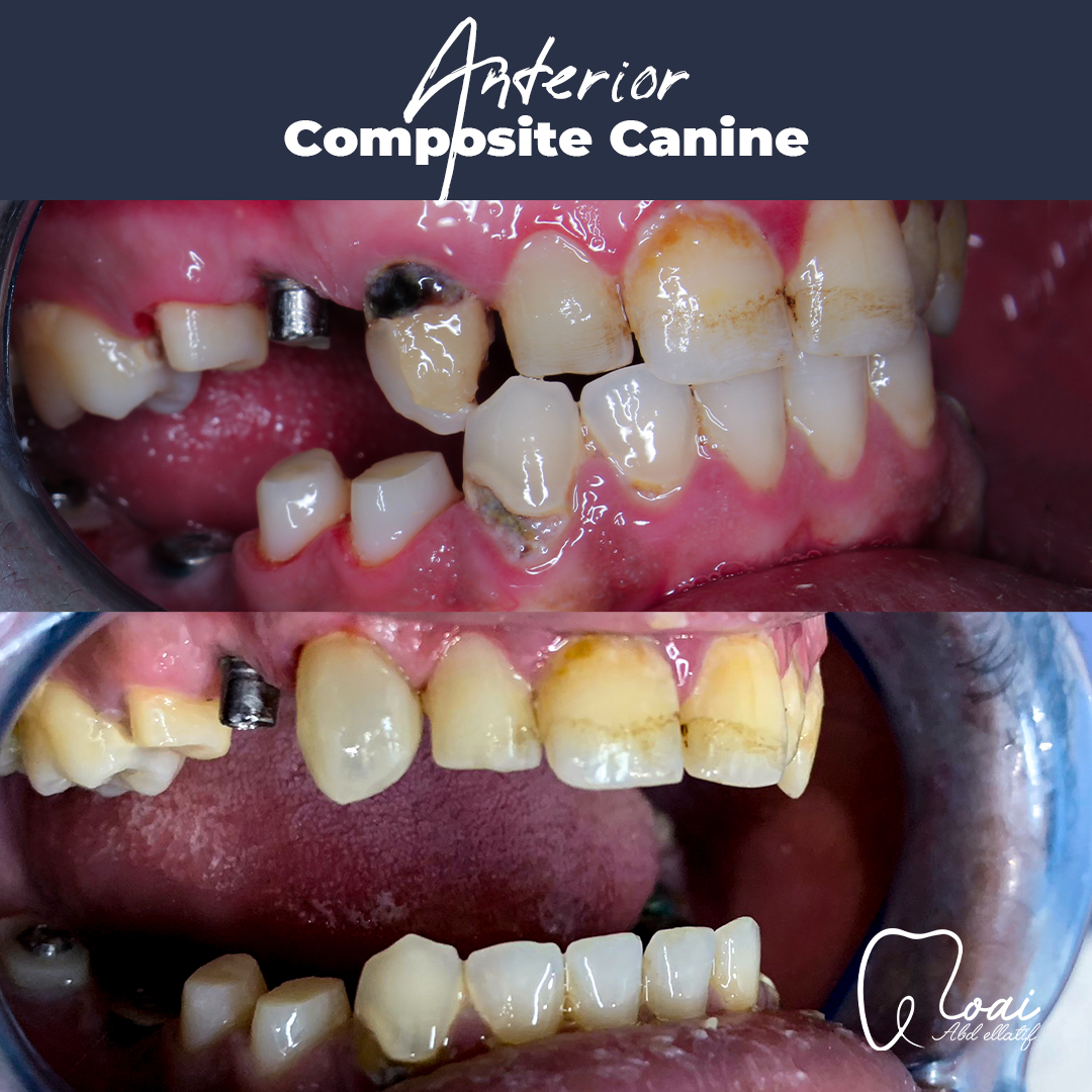 anterior-composite-canine